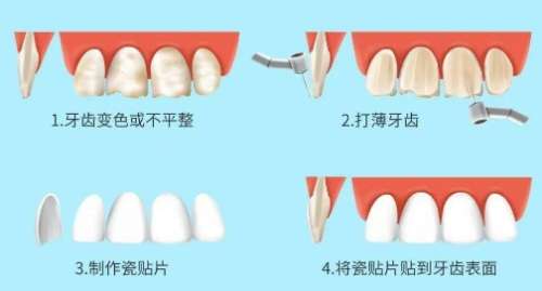 美白牙齿一次多少钱？能维持多久？
