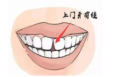 补牙缝要多少钱？相关科普知识已经全部收集