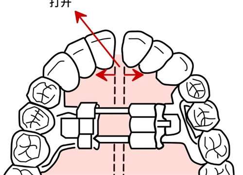 武汉整牙齿矫正多少钱？牙齿矫正有哪些方式？