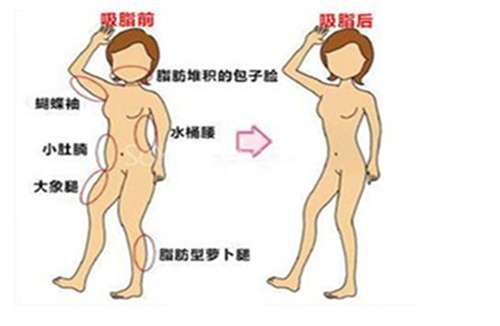 上海美莱医疗美容门诊部抽脂价格?特色项目了解
