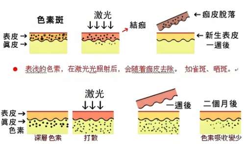 超光子嫩肤多久做一次？超光子嫩肤多久见效？  