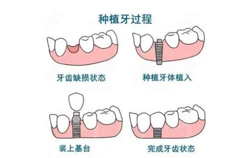种植牙修复并发症以及处理方法有哪些?恢复周期介绍