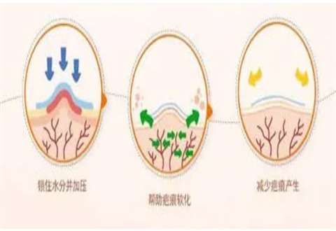 激光祛疤能彻底去掉吗?通常需要几次?全新解答