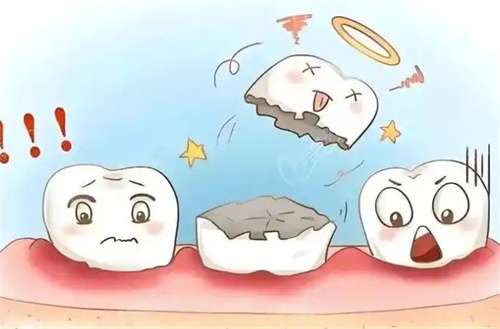 纳米烤瓷牙怎么样?纳米烤瓷牙使用寿命多久?