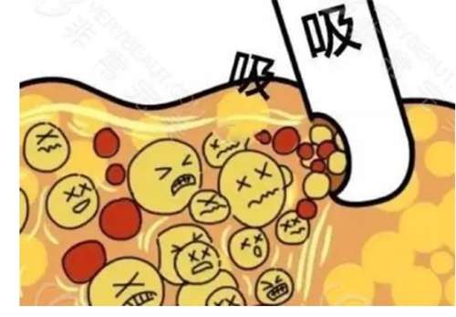 手臂抽脂肪一般多少钱？术后会反弹吗？