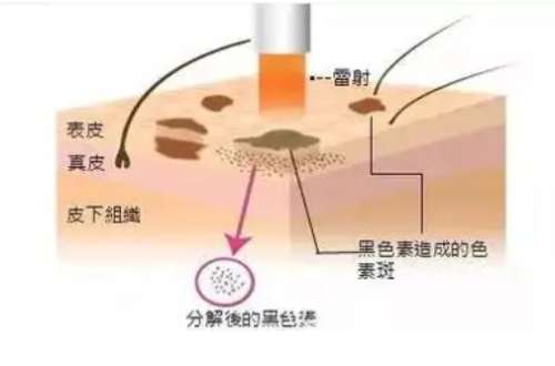超皮秒洗纹身机器多少钱一台？术后护理