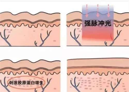 超声波抗衰效果怎么样？超声波抗衰老有没有副作用？