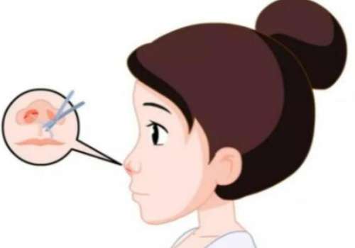 耳软骨假体隆鼻可以吸收多少?可以维持多久?