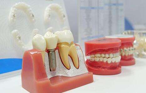 上海种植牙医院排名榜有哪些？性价比高、技术靠谱的整理了