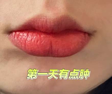 纹唇一到七天恢复图片怎样?恢复全过程公布