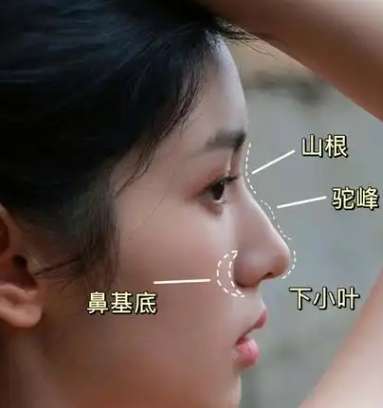 驼峰鼻矫正整形技术如何?特点和基本情况一一分析