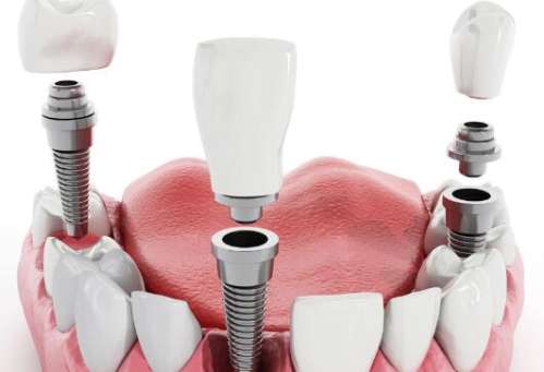 临平种植牙齿哪家医院好？本地人分享这些医院上榜