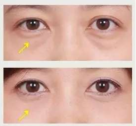 宁波祛眼袋医院大揭秘:哪家好?排名靠前的五家医院全攻略
