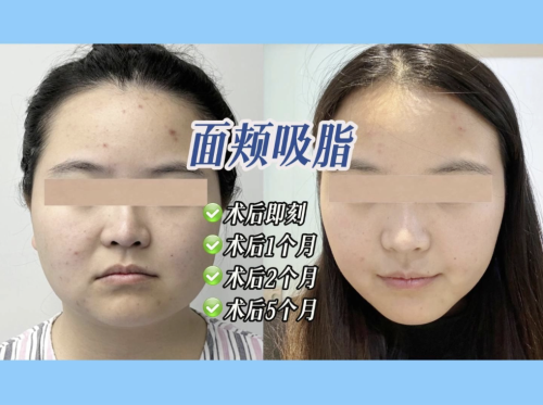 瘦脸面部吸脂术要多少钱一次?揭开价格秘密!