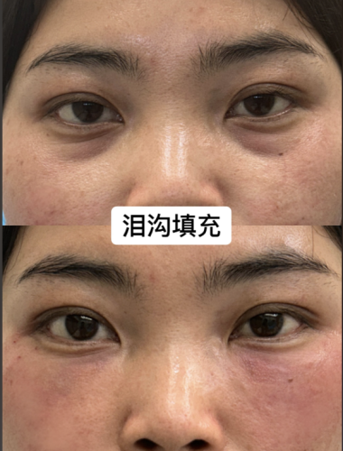 泪沟填充可以维持多久？揭秘美丽续航时间