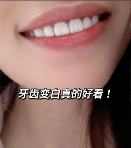 怎样使牙齿变白?亮白全攻略,解锁自信笑容的密码