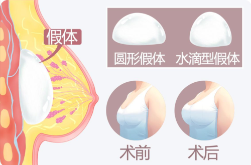 南京假体隆胸哪家医院好?假体隆胸体验实录