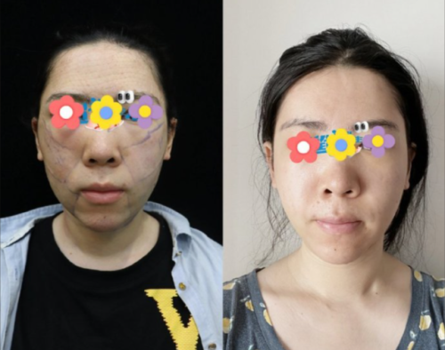 马梅生面部吸脂怎么样？把脸蛋的 “多余肉肉” 请出门的高手