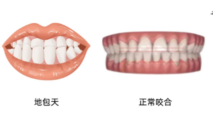 地包天轻微与严重图片,影响颜值可一定要重视