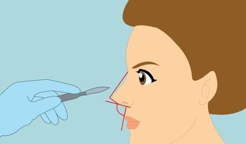 宁波隆鼻医生哪个技术好？鼻型处理与项目搭配各有巧思
