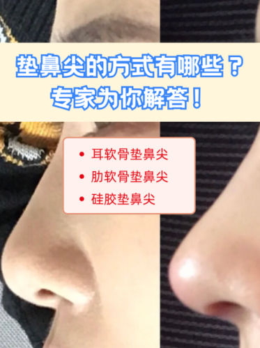 如何垫鼻梁比较融合？让新鼻梁像 “天生长出来” 的