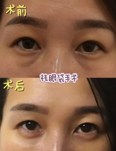 北京哪里做眼袋比较好?综合实力突出医院一览表