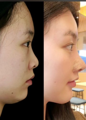 呼和浩特肋骨鼻医院排名,塑美鼻韵看这里