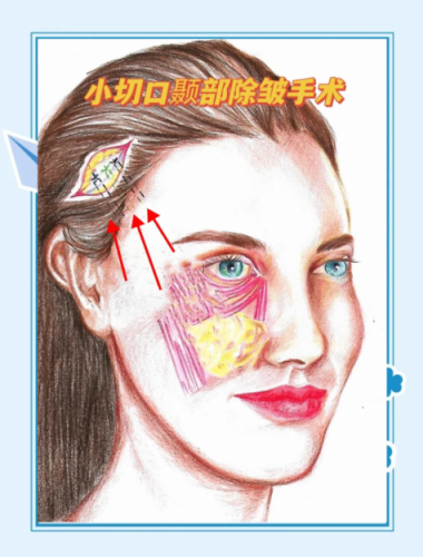 小切口除皱术的危害有哪些？真的安全吗？