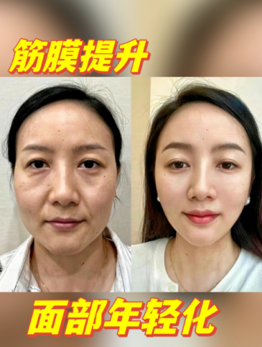 北京筋膜提升医院排名,你pick的医院在里面吗?