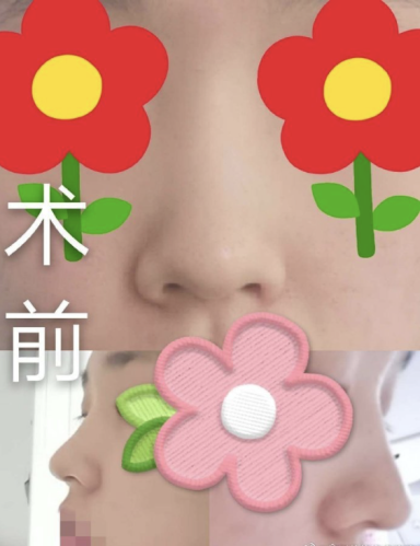 杭州刘中策做鼻子怎么样？技术水平和口碑表现如何？