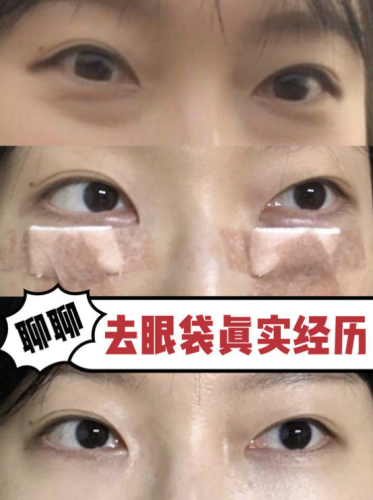 宁波去眼袋的正规医院：天花板级别的机构推荐