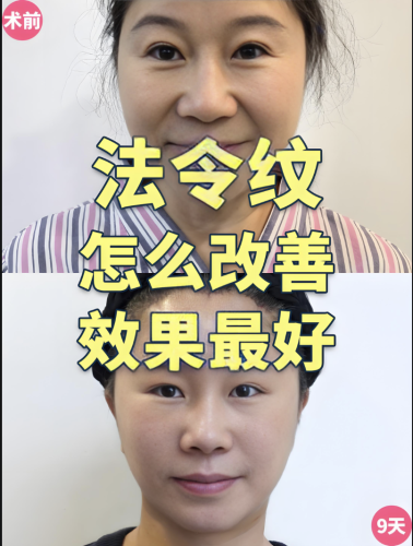 填法令纹用什么好？哪种材料更合适？