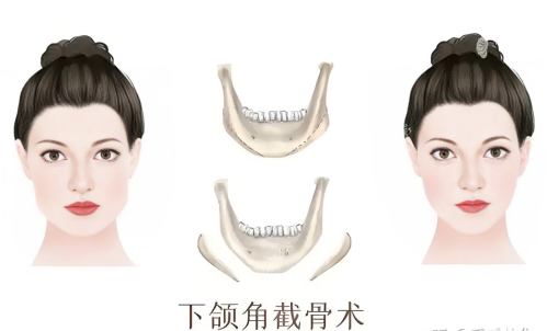 切下颌角多久恢复？展开说说