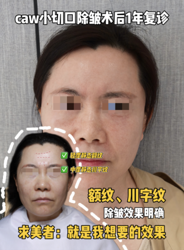 烟台烟台山医院除皱手术怎么样?直接看价格表,主打一个明明白白消费!
