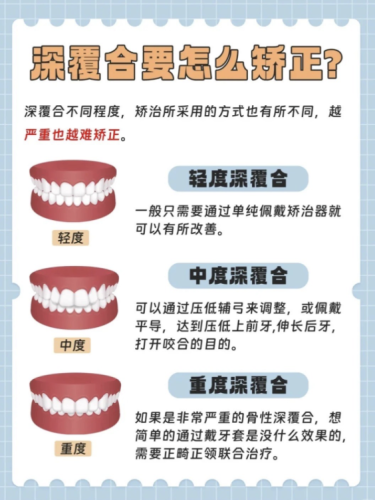 深覆合怎么矫正？今天这篇干货直接给你整明白！
