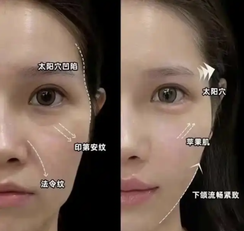 面部填充哪种安全？找对医院找对人，风险可控