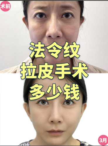 包头中心医院拉皮除皱多少钱？找对医生、选对方案，别花冤枉钱