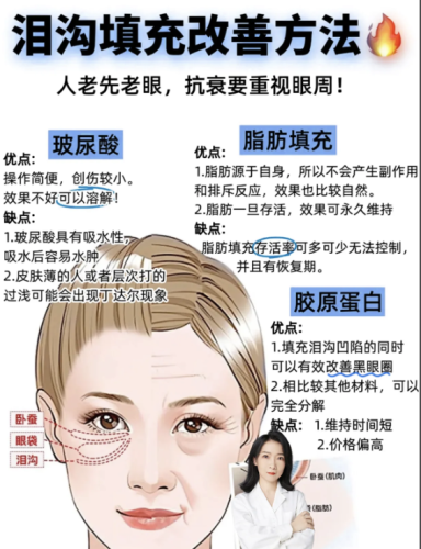 泪沟填充用什么方法好？今天就来一波超全测评