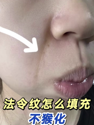 填法令纹后遗症什么材料好？材料选择与后遗症剖析