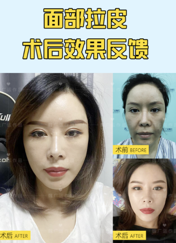 东台中医院拉皮除皱多少钱?看完再冲不迷路!