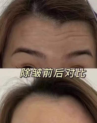 菏泽中医医院拉皮除皱多少钱？材料选择有讲究