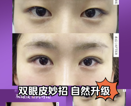 漳州第三医院割双眼皮多少钱？双眼皮价格总览