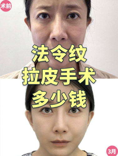 北京复兴医院拉皮除皱多少钱？ 医院靠谱，价格有说法