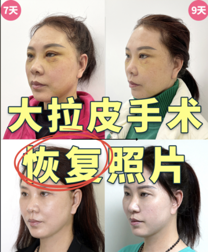 韶关第一人民医院拉皮除皱多少钱？医院面诊，get专属报价！