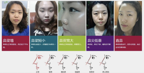 北京航天总医院做鼻子多少钱?这些方面都会影响手术的定价