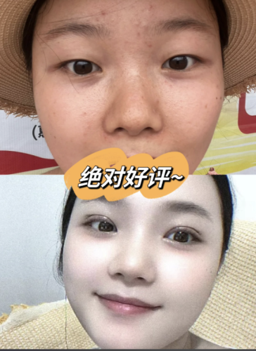 福州福建省第二人民医院割双眼皮多少钱?今天来把这笔账算清楚