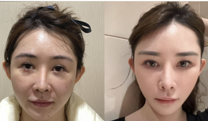 荆州第二人民医院拉皮除皱多少钱？该医院是既划算又有效的选择