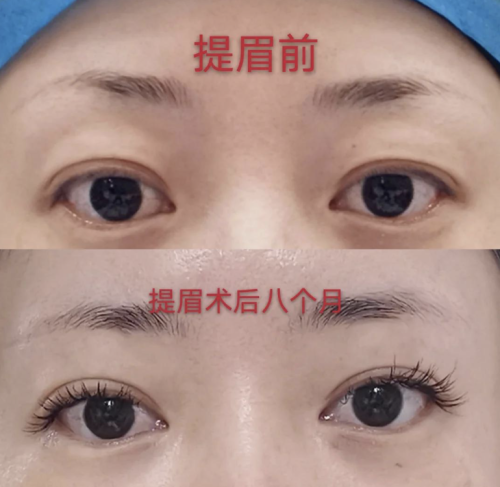 提眉术多久可以恢复自然?术后1个月左右就可以