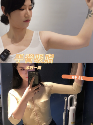 日照中医医院抽脂好吗？价格实用参考如下