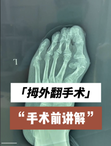 大脚骨手术后遗症有哪些?提前了解这些坑,术前能少踩雷